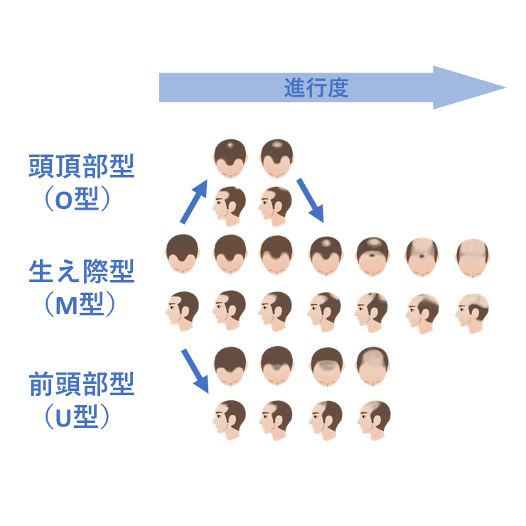 フォリックスFRクラシック